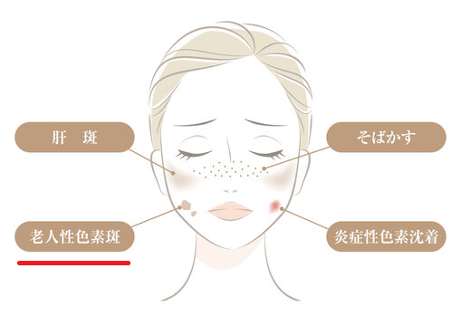 老人性色素斑