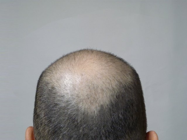 薄毛や抜け毛を予防するため